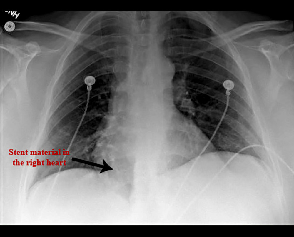 Preoperative chest X-ray. Displaced venous vascular stent projected over the right heart in anteroposterior view.