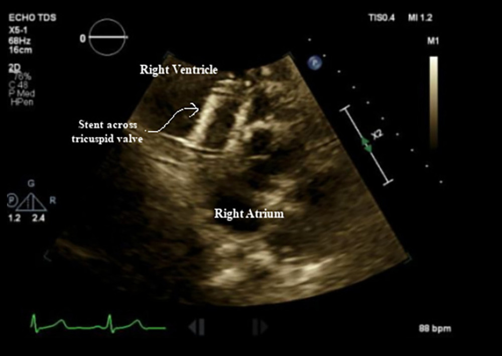 Preoperative echocardiogram showing migrated stent. Zilver Vena stent, sized 16×60 mm, which has migrated and is seen stuck across the tricuspid valve.