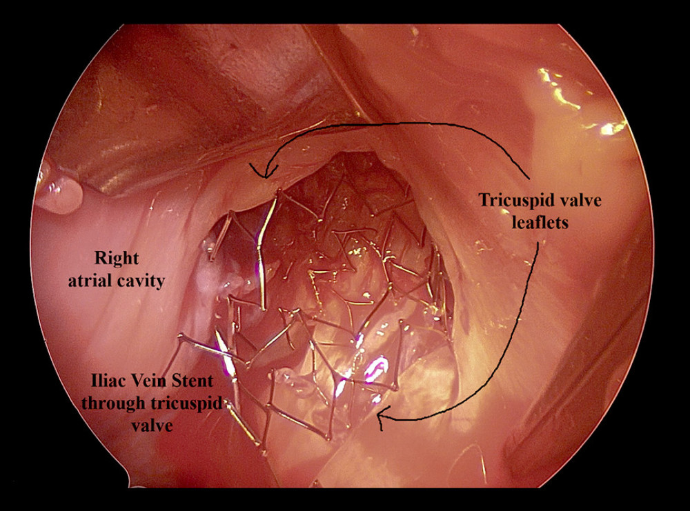 Stent visualized in the right atrium after incision. The stent, which was stuck on the tricuspid valve, was easily visualized after opening the right atrium obliquely.