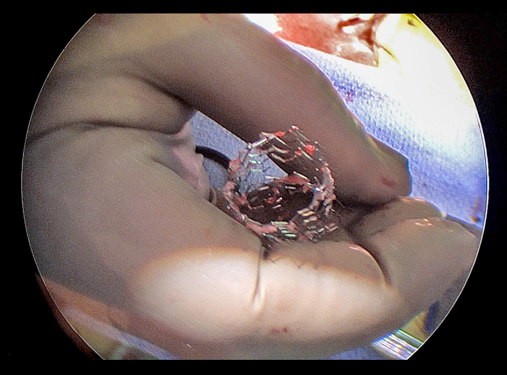 Stent material after completion of the procedure. Stent shown in surgeon’s hand after surgical removal.