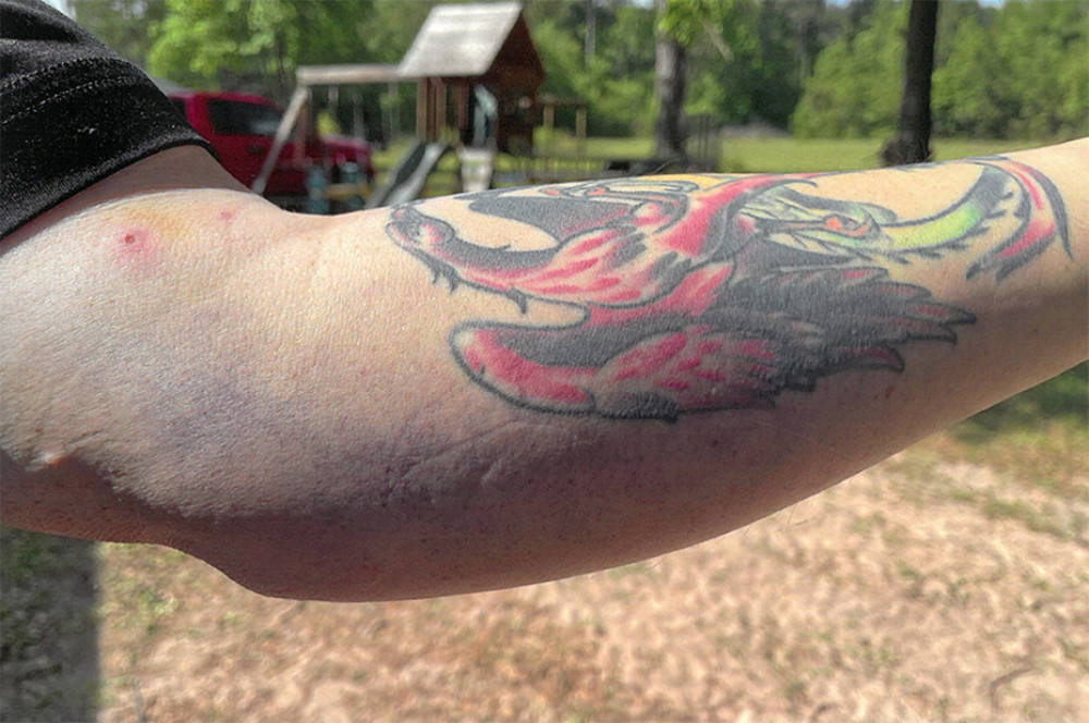 Punctate lesions of left arm as well as progressive ecchymosis.