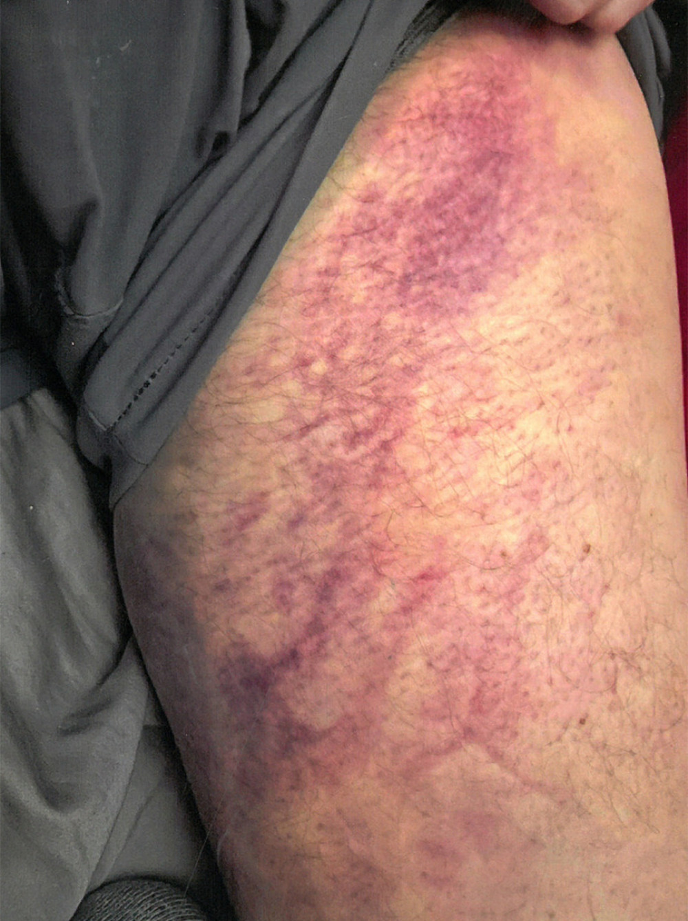Ecchymosis of left thigh.