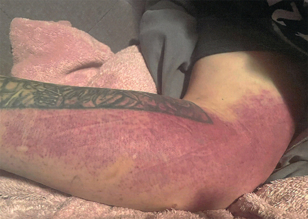 Ecchymosis of right arm/forearm.