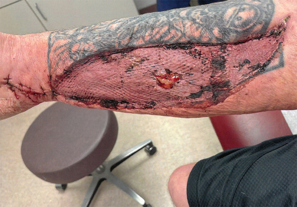 Post-fasciotomy of right arm.