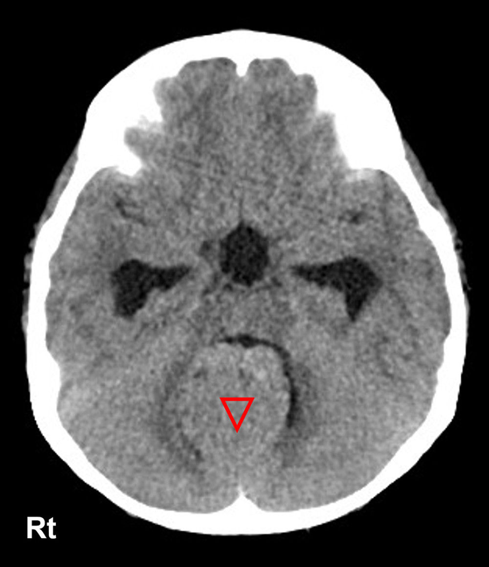 Preoperative brain computed tomography image showing a brain tumor (∇) in the cerebellar vermis, complicated with lateral and third-ventricle enlargement.