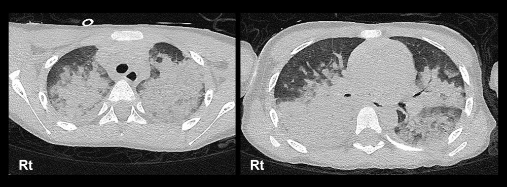 Chest computed tomography images showing wide-spread consolidation, mostly located in the dorsal regions of the bilateral lung fields and suggesting severe pulmonary edema.