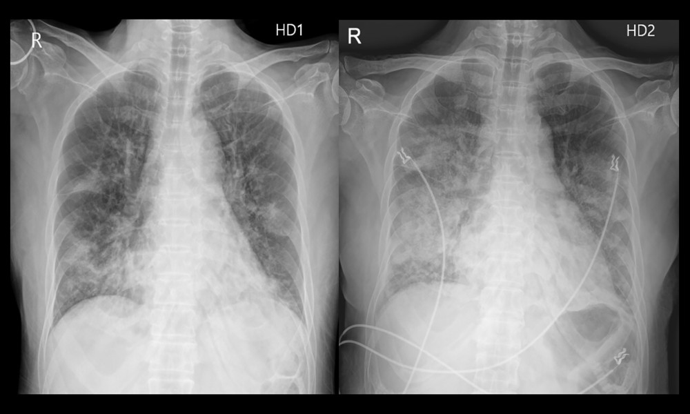 Chest X-rays on hospitalization days 1 and 2 showing rapid progression of infiltration, with diffuse bilateral haziness, predominantly in both lower lung fields.