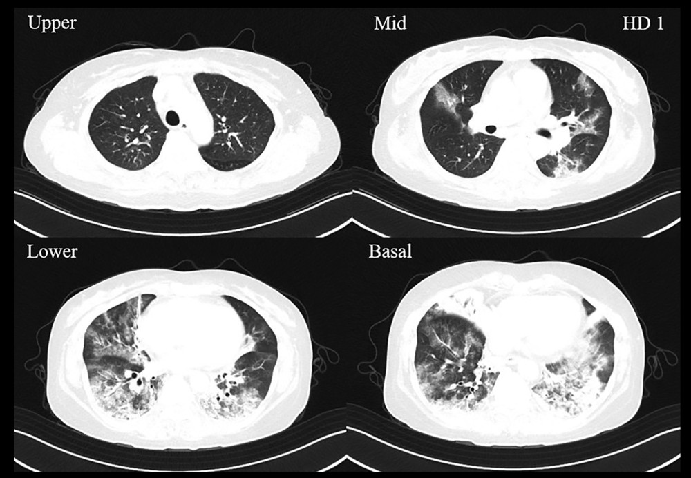 Initial chest computed tomography scan on hospitalization day 1 showing multifocal GGOs and consolidations in both lungs, mainly both lower lobes.