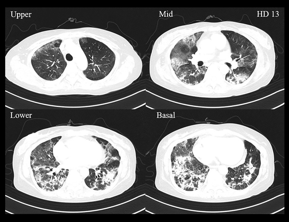 Chest computed tomography scan on hospitalization day 13 showing newly noted ground glass opacities (GGOs) and patchy consolidations in both upper lobes, In lower lobes, consolidation was decreased, but overall GGOs and air trapping was increased, and fibrotic change was newly noted. It manifested a more organizing pneumonia pattern rather than a nonspecific interstitial pneumonia pattern.