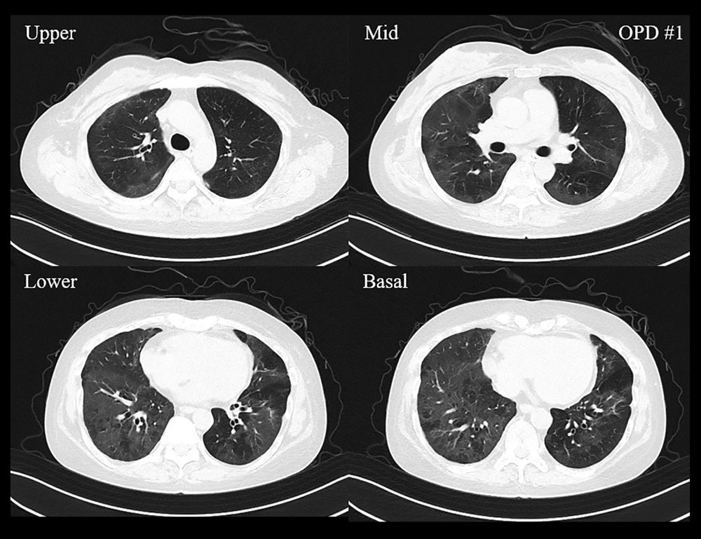 Chest computed tomography performed at 2-month outpatient follow-up. The previously seen ground glass opacities and consolidation in bilateral lungs disappeared and air trapping remained.
