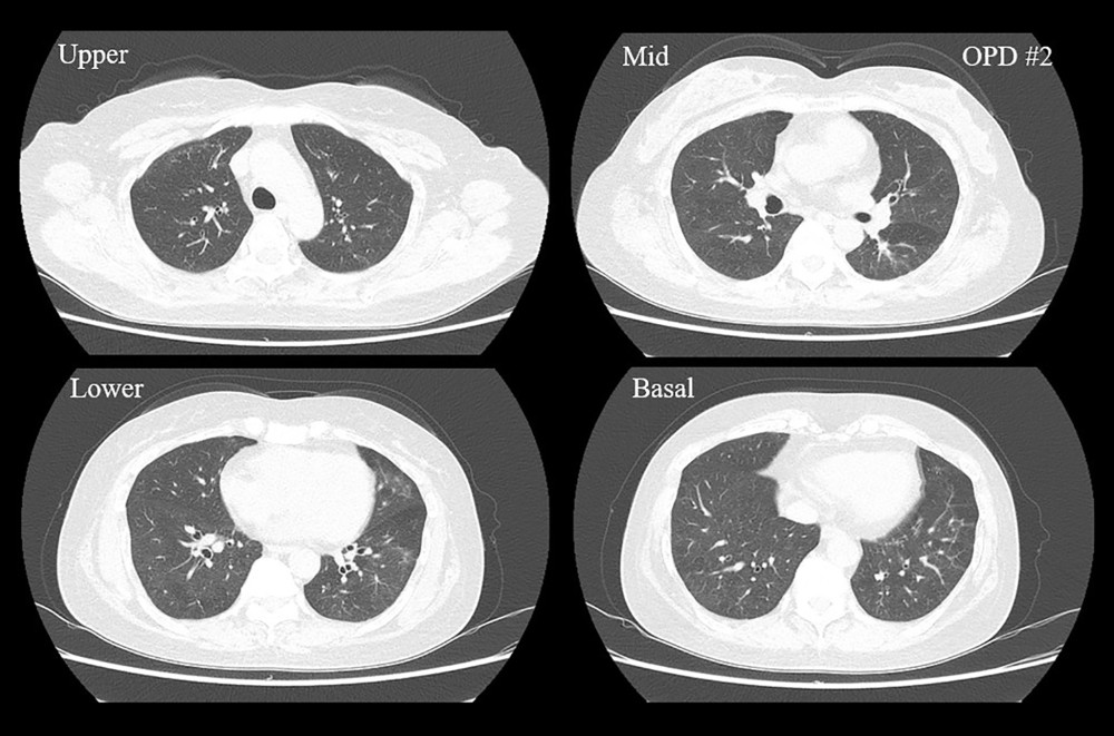 Chest computed tomography performed at 6-month outpatient follow-up. The previously seen air-trapping in bilateral lungs disappeared.
