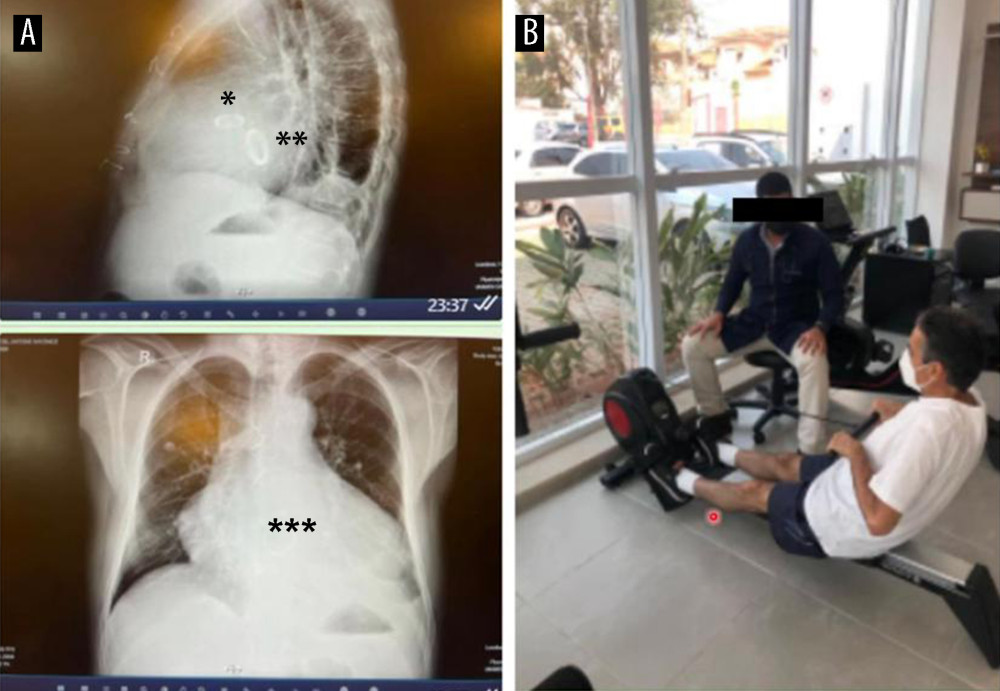 Chest X-rays (2 views) of the patient on the day of discharge (A). Note the mechanical prostheses in the aortic (*) and mitral (**) positions and the significant enlargement of the heart chambers (***). The same patient underwent cardiopulmonary rehabilitation 10 days after discharge (B).