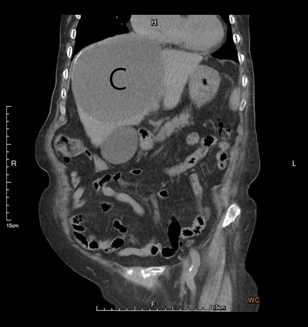 Coronal view CT images of the liver. The hydatid cyst is marked as “C”.