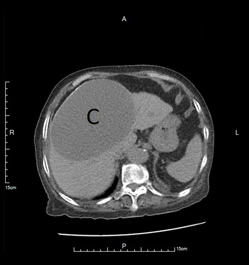 Transverse view CT images of the liver. The hydatid cyst is marked as “C”.
