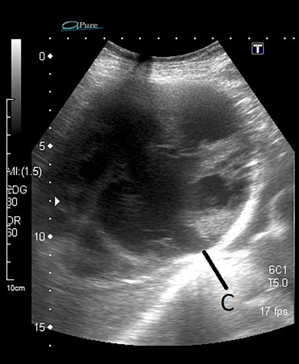 Sonographic image of the liver. The hydatid cyst is marked as “C”.
