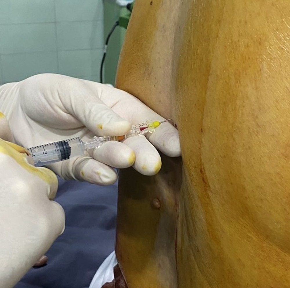 Performing thoracic spinal anesthesia at Th10-11 with 27-G spinal needle.