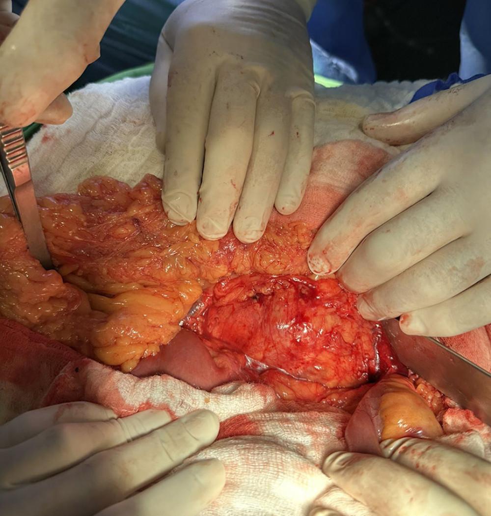Abdominal aortic aneurysm before removal of the aneurismatic part.