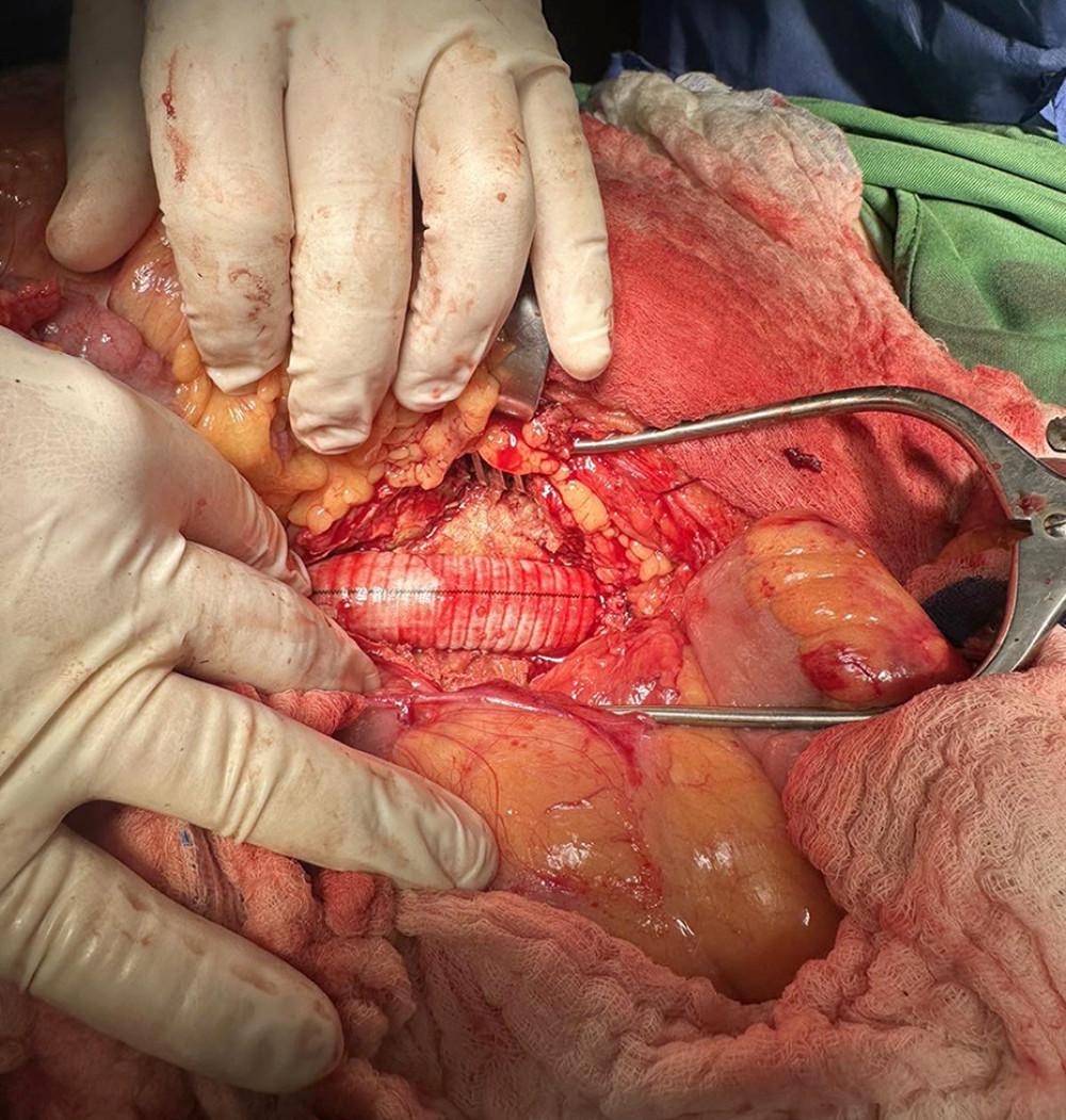 Aorta abdominalis after placement of an aortic vascular graft.