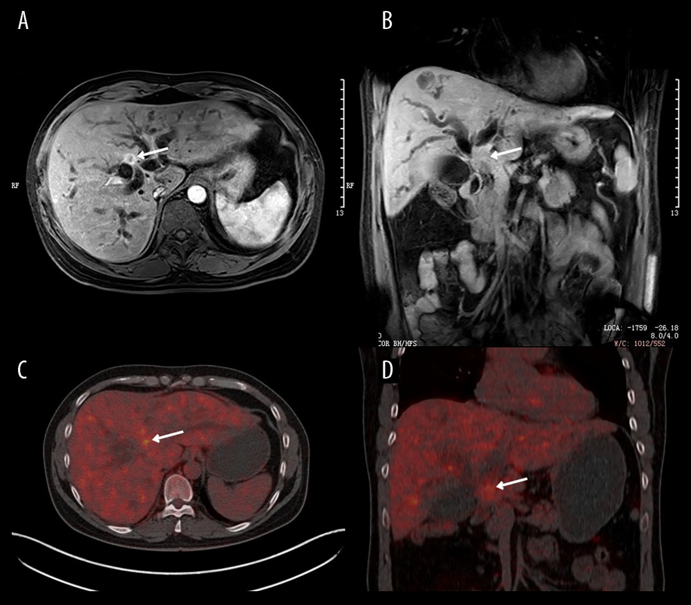 Preoperative MRI and PET-CT Imaging. (A, B) Represent enhanced magnetic resonance imaging (MRI) of the liver. A low signal intensity nodule is observed in the left medial segment of the liver, adjacent to the first porta hepatis, on the T1-weighted image. Following contrast administration, this nodule demonstrates significant arterial phase enhancement, accompanied by sustained enhancement during the portal venous and delayed phases. Furthermore, intrahepatic bile duct dilation is visualized. (C, D) Depict 18F-FDG positron emission tomography-computed tomography (PET-CT) images. In the porta hepatis region, a nodular soft tissue lesion measuring approximately 2.2 cm in its longest dimension is evident. This lesion exhibits increased FDG metabolism, with a maximum standardized uptake value (SUVmax) of approximately 4.4.