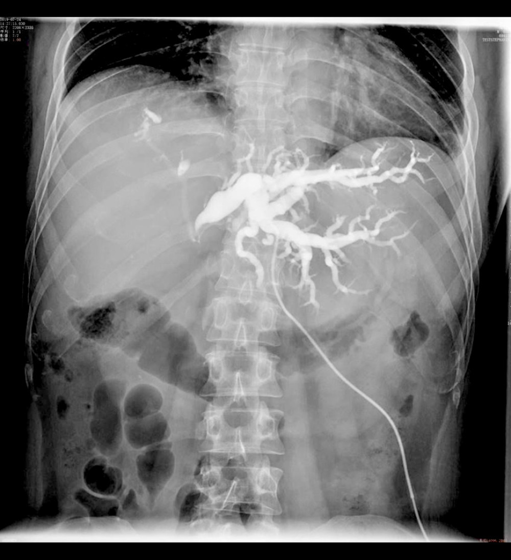 Preoperative PTCD angiography showing the placement of the bile drainage to lower the bilirubin concentration and alleviate jaundice.