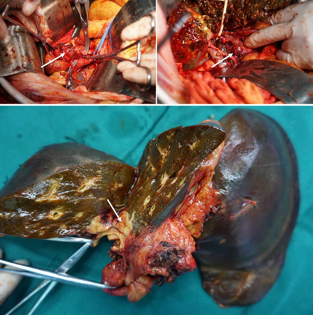 Intraoperative images. (A) The mass in the hilar region of the liver. (B) Enlarged lymph nodes are visible in the hepatic hilar region. (C) Resected liver with hilar mass (arrow).