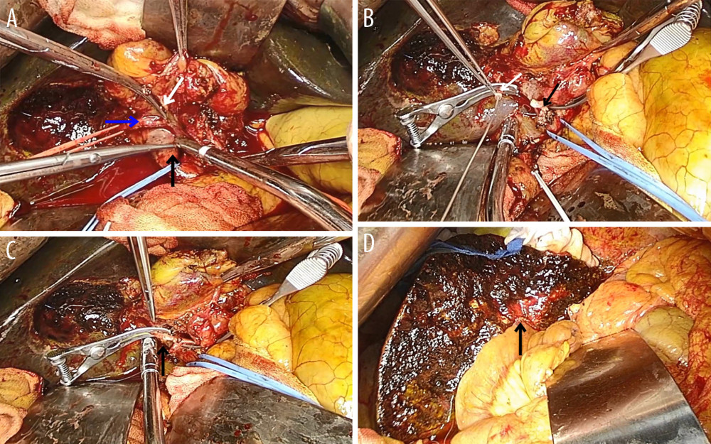 Intraoperative images showing the (A) Right hepatic artery (blue arrow) and hepatic portal vein (black arrow). Tumor invading the right hepatic artery (white arrow). (B) The distal portion of the right hepatic artery (white arrow), and the proximal portion of the right hepatic artery (black arrow). (C) Reconstruction of the right hepatic artery. (D) Biliary-enteric anastomosis (black arrow).