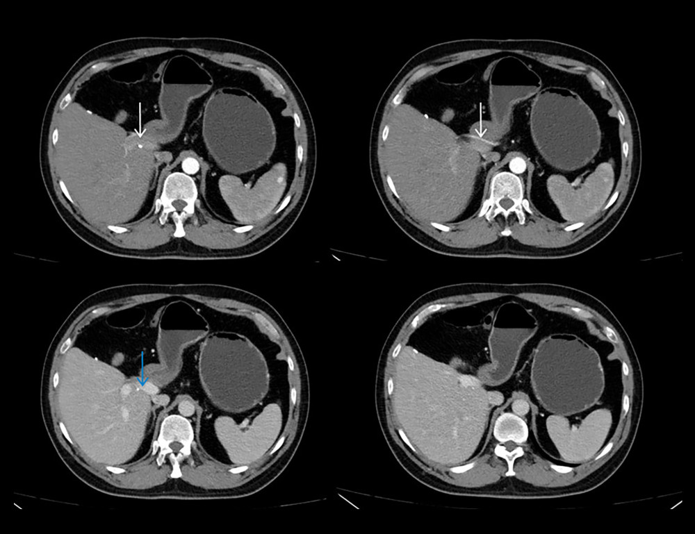 Postoperative CT Imaging of the liver showing a patent right hepatic artery (white arrow) and no tumor recurrence (blue arrow).