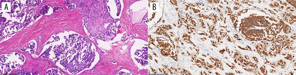 Postoperative pathology examination results. (A) Tumor cells exhibit epithelial-like morphology arranged in a nest-list pattern with collagen separating the stroma. There is abundant blood sinus within the tumor, with nerve invasion. (B) Tumor cells show diffuse expression of Syn protein.