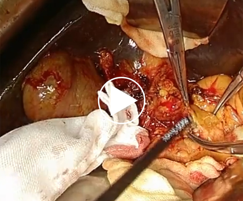 Extended left hemi-hepatectomy with caudate lobe and extrahepatic bile duct resection.