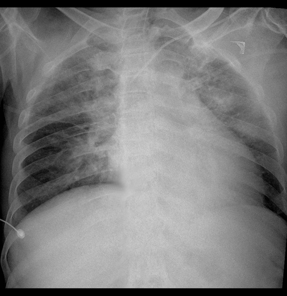 Chest radiograph on admission suggested pulmonary edema.