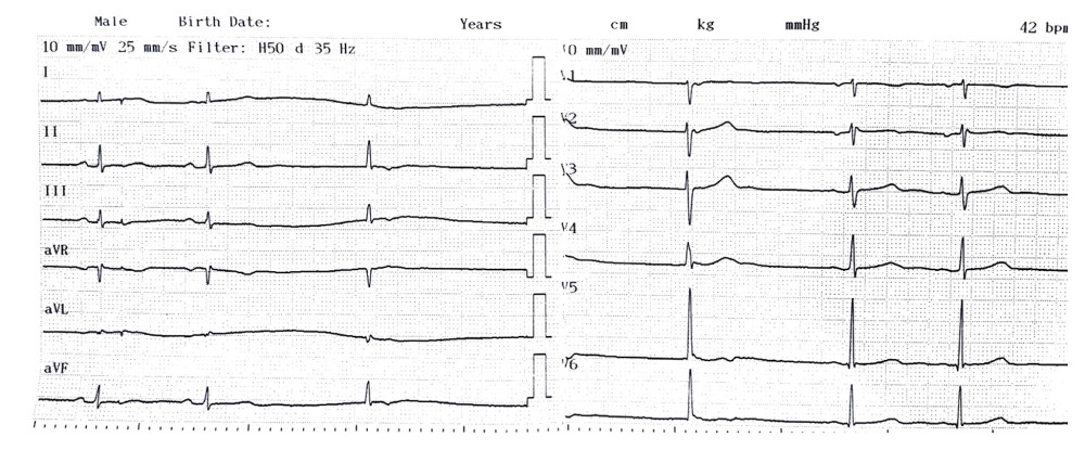 ECG on admission showed sinus bradycardia with junctional escape beats.