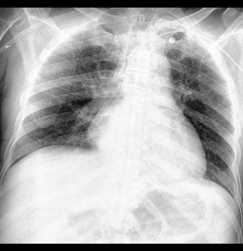 Chest radiograph on day 2 showed improvement of pulmonary edema.