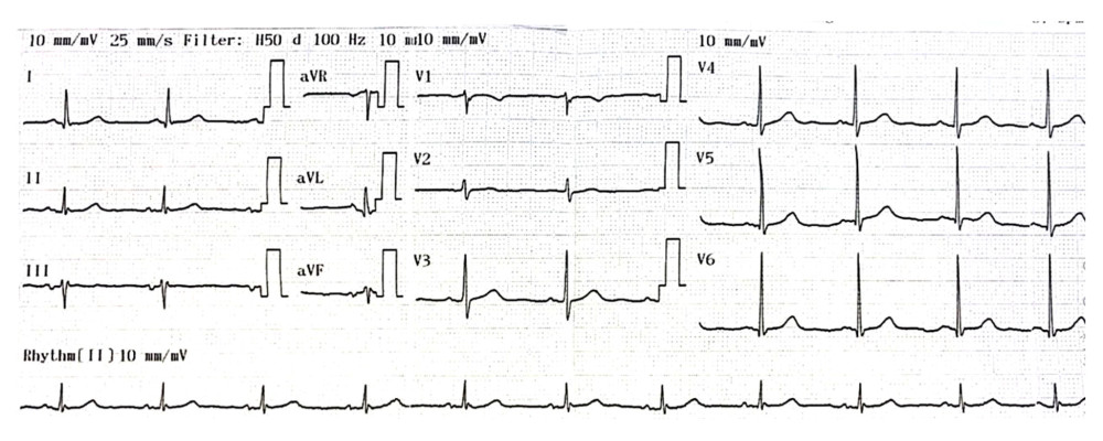 ECG on day 2 showed the return to sinus rhythm.