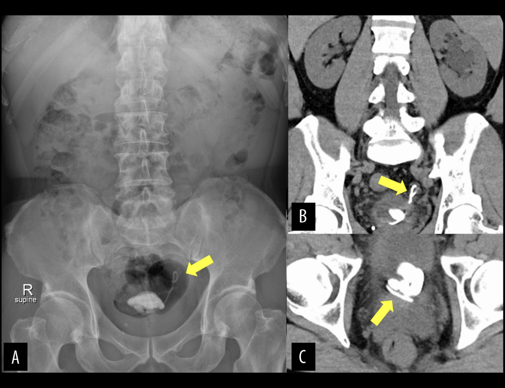 Preoperative imaging assessments of the patient’s bladder stone with a coiled irregular hyperdense object (yellow arrow) in (A) kidney ureter bladder radiograph and computed tomography in (B) coronal and (C) axial planes.