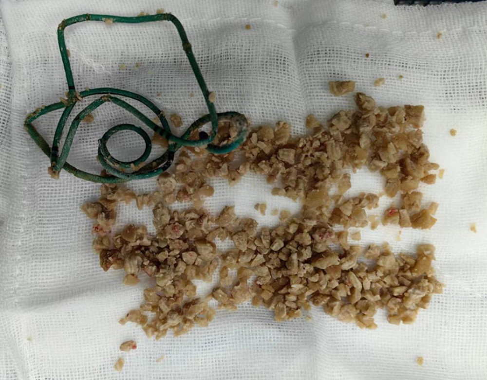 Intraoperative image of the pulverized bladder stone fragments and the D-J stent with signs of encrustation.