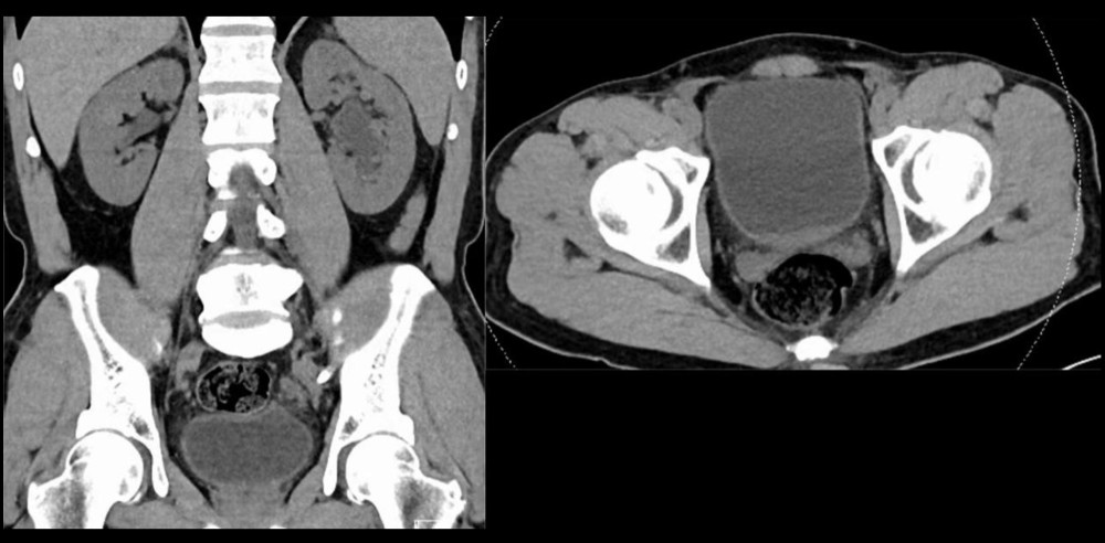 Postoperative CT evaluation found no residual double-J stent or bladder stone.