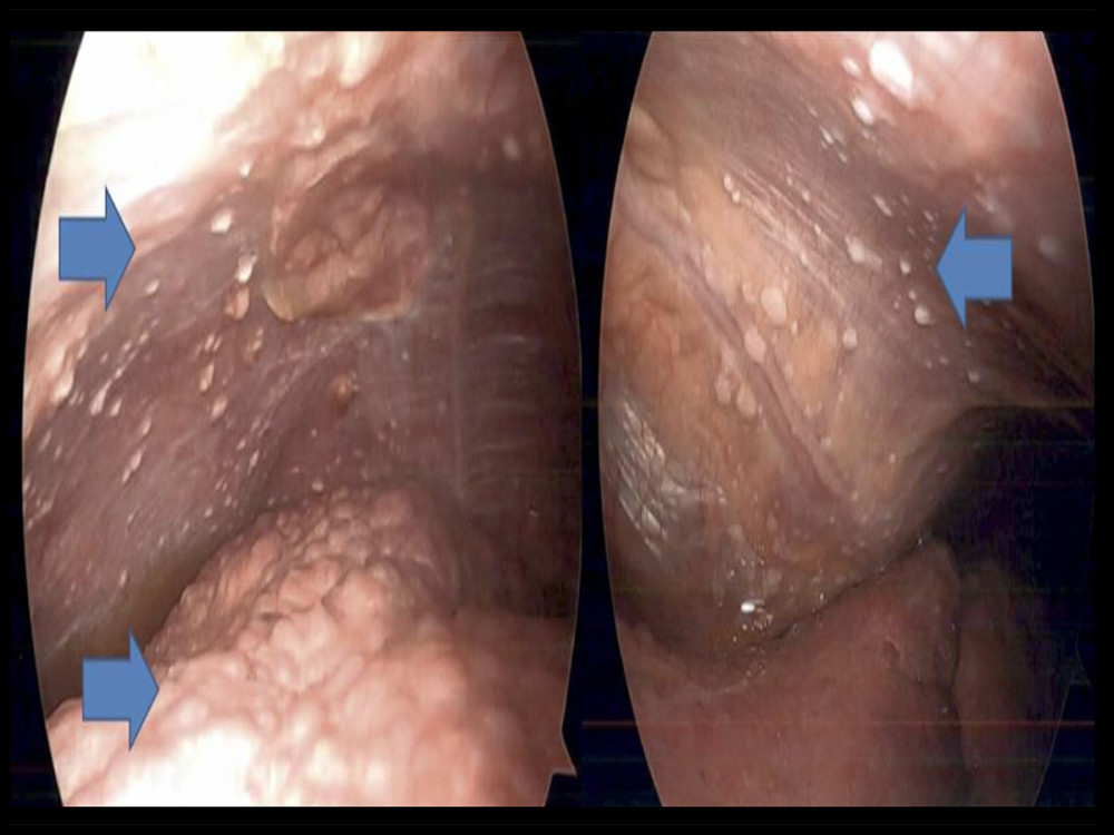 Diffuse peritoneal mesothelioma visualized on laparotomy. Findings: Multiple peritoneal nodules noted on the right diaphragm during exploratory laparotomy.