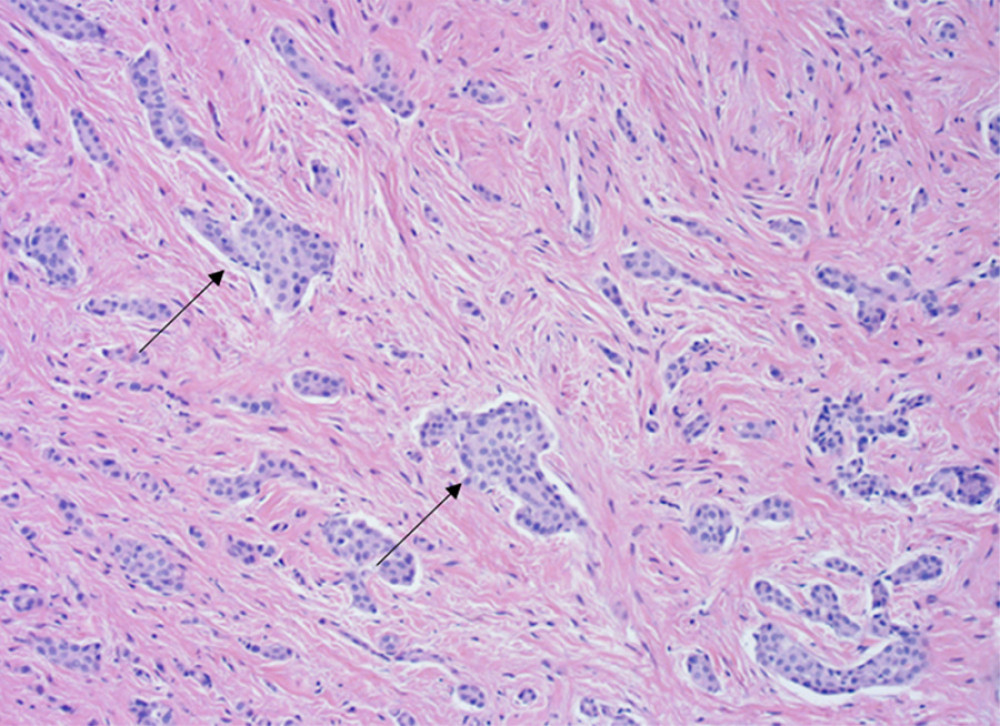 Histological findings of the peritoneal mass with hematoxylin and eosin staining. Microscopic examination: 2-mm internal scale; 100× power of magnification, transverse plane, and hematoxylin and eosin stain. Findings: Sections demonstrate infiltrative atypical mesothelial proliferation forming tubules and trabeculae. The overall cytology is low-grade with occasional prominent nucleoli. There are no significantly increased mitoses or necrosis.