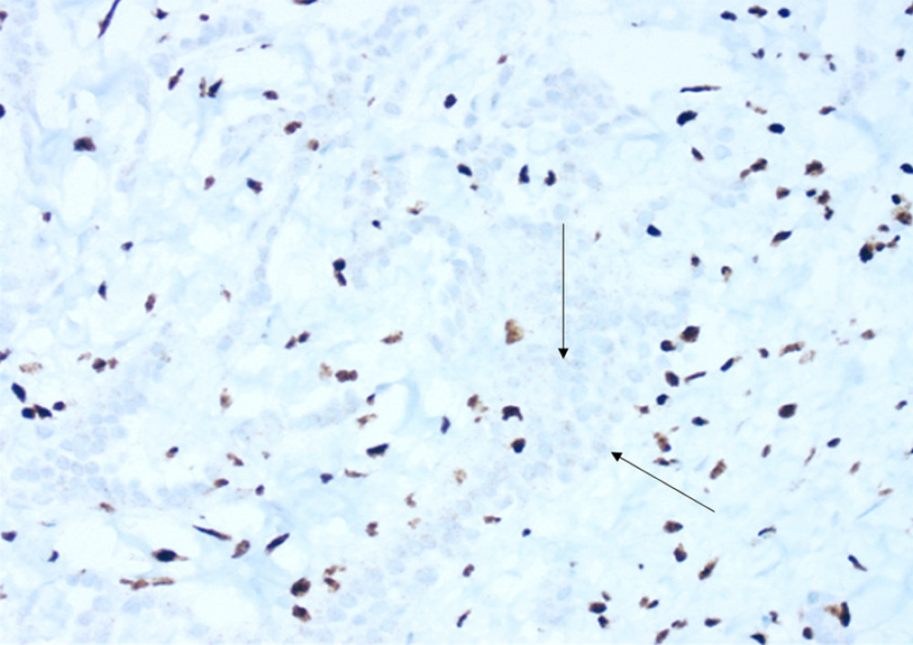 BAP1 shows loss of nuclear staining in a subset of mesothelial cells. Microscopic examination: 2-mm internal scale; 100× power of magnification, transverse plane, and BRCA1-associated protein 1 (BAP1) specialized immunochemistry. Findings: BAP1 shows patchy loss of nuclear staining in mesothelial cells. The overall findings represent a low-grade epithelioid mesothelioma.