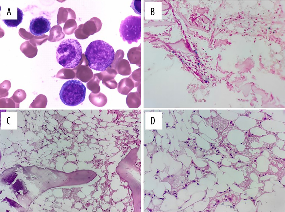 (A) Bone marrow smear showed hypoplasia, and no megakaryocytes were seen (Jenner-Giemsa stain, 400×). (B) Bone marrow iron stain was positive (++; iron stain, 200×). (C, D) Bone marrow biopsy showed about 10% cellularity and most of the hematopoietic tissue was replaced by adipose tissue (hematoxylin-eosin stain, 200× and 400×, respectively).