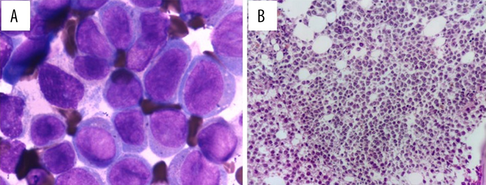 (A) Bone marrow smear showed marked hyperplasia and increased blasts with monocytic morphology (Jenner-Giemsa stain, 400×). (B) Bone marrow biopsy showed infiltration by immature cells (hematoxylin-eosin stain, 400×).