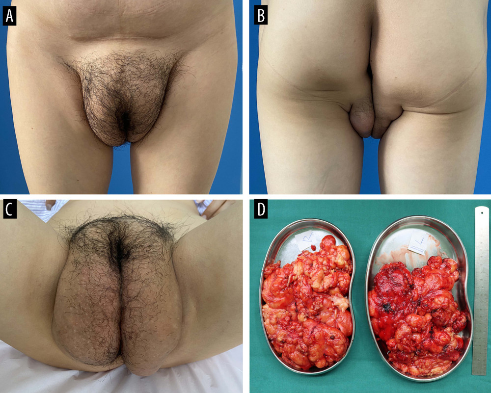 Clinical appearance of the patient (A–C) and the excised tissue (D).