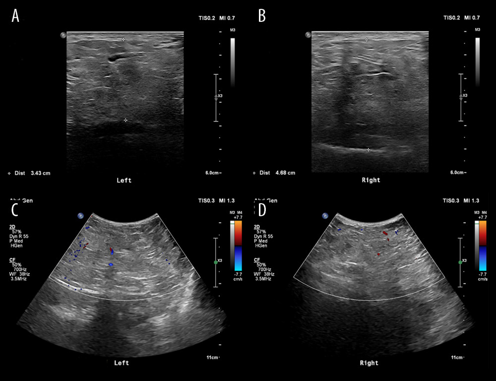 B-ultrasonic images of the mass. Perineal subcutaneous fat-like echoes with unclear borders (A, B). A small amount of blood flow signal within the mass (C, D).