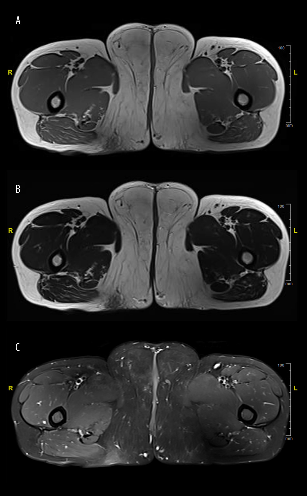 MRI images of the mass. (A) T1-mapping of the mass. (B) Soft-tissue mass of high-signal intensity. (C) T2-mapping of the mass. Soft-tissue mass of high-signal intensity with low-signal intensity fibrous septa. T2-mapping of fat suppression. Soft-tissue mass showing low-signal intensity.