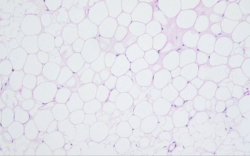Histological image of the mass (200×). BSL appears as proliferated fat tissue, which is indistinguishable from normal fat.