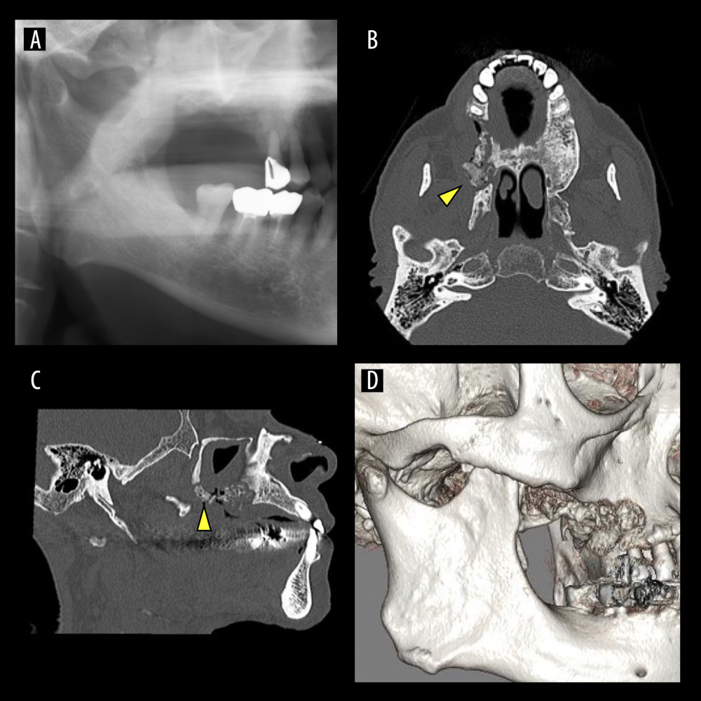 Panoramic radiograph and computed tomography images. (A) Panoramic radiograph showing bone resorption in the posterior portion of the right maxillary labrum. (B) Computed tomography (CT) image showing necrotic bone extending to the base of the pterygoid plate (arrowhead). (C) The necrotic bone extends to part of the posterior wall of the maxillary sinus and the pterygopalatine fossa on CT (arrowhead). (D) Three-dimensional CT image of eroded bone resorption and necrotic bone.