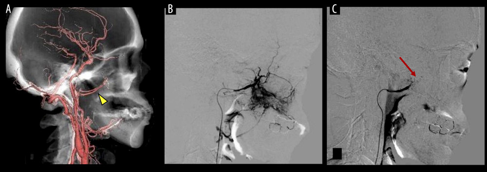 Computed tomography angiography image of the maxillary artery and its branches and angiographic images. (A) Computed tomography angiography (CTA) showing a branch of the maxillary artery (ie, the posterior superior alveolar artery; arrowhead) located peripherally from the middle meningeal artery. (B) Preembolization angiography showing blood flow in the maxillary artery branches. (C) Post-embolization angiography showing that coil implantation (arrow) had cut off the arterial blood supply around the pterygoid plate.