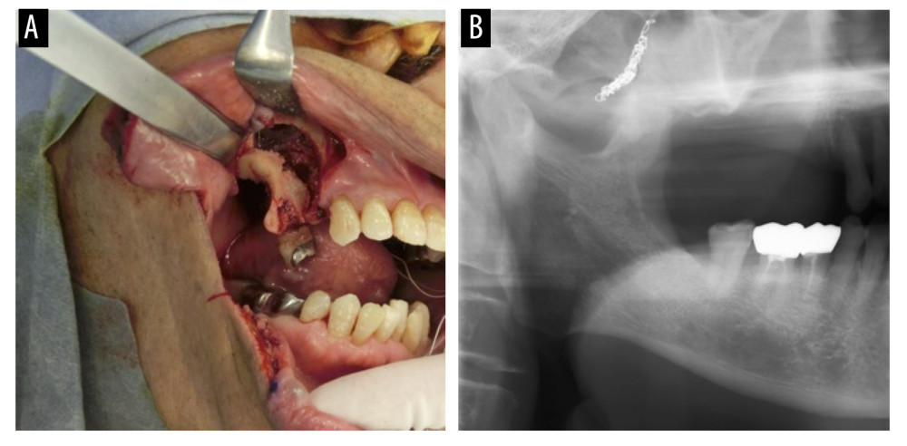 Surgical findings and postoperative panoramic radiography. (A) Intraoperative photograph of the partial maxillectomy. (B) Postoperative panoramic radiograph showing that the micro-coil had remained in place.