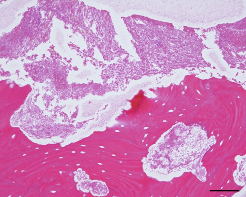 Histologic features of the resected maxillary portion ruled out myeloma and confirmed the diagnosis of BRONJ Hematoxylin-eosin (HE) staining shows necrotic bone around the bone tissue (Scale bar: 100 µm).