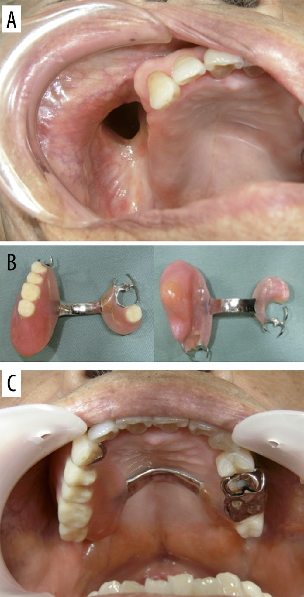 Post-healing oral cavity and maxillary jaw denture. (A) The surface of the resected bone fragment was epithelialized, and the open sinus into the maxillary sinus was held open. (B) Maxillary jaw denture that can close the open sinus area. (C) Maxillary denture was placed. The open sinus was closed by the denture.